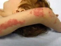 HPV при мъжете