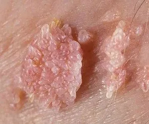 HPV при мъжете
