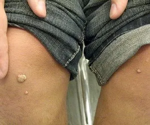 HPV при мъжете