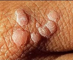 HPV при мъжете