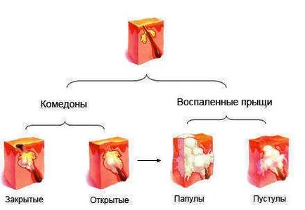Акне, което е в тях