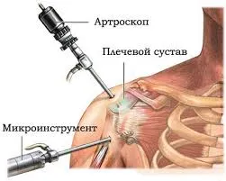 Как да се възстанови на хрущяла