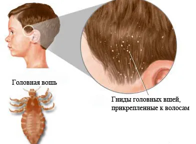 Какво е въшки на детето Какво е въшки на детето