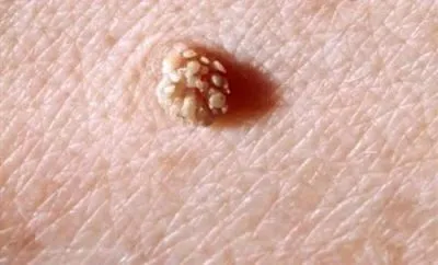 HPV при мъжете