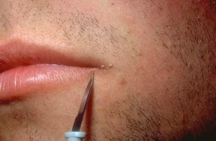 HPV при мъжете