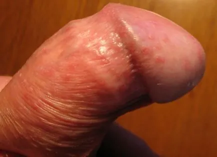 HPV при мъжете HPV при мъжете