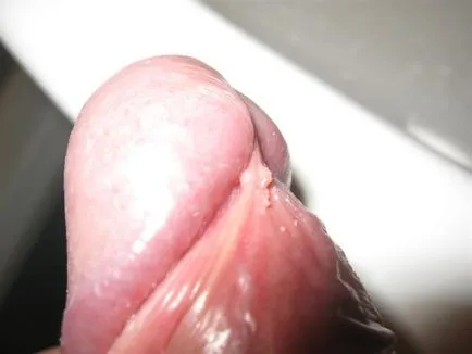 HPV при мъжете HPV при мъжете