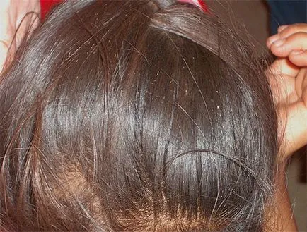 Какво е въшки на детето Какво е въшки на детето