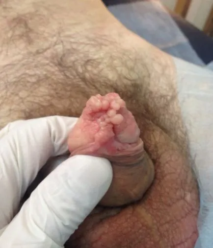 HPV при мъжете HPV при мъжете
