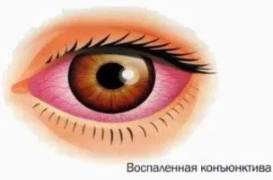 Какво е хроничен конюнктивит Какво е хроничен конюнктивит