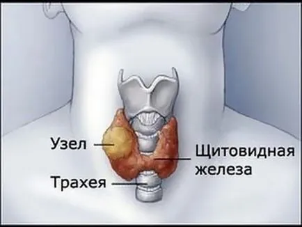 Какво е хронично автоимунно тиреоидит