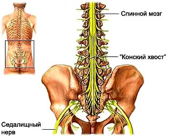 Какво да правите, ако на седалищния нерв болката