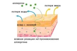 Алергия към прах за пране детето симптоми, лечение (снимка)