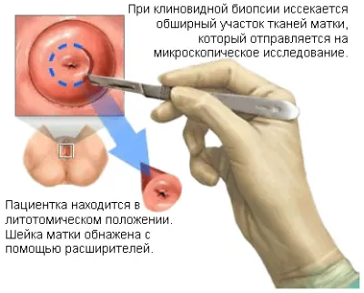 маточната шийка биопсия