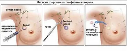 Биопсията и неговата роля в диагнозата и лечението на рак (видове биопсии) Биопсията и нейната роля в диагностиката и лечението на рака