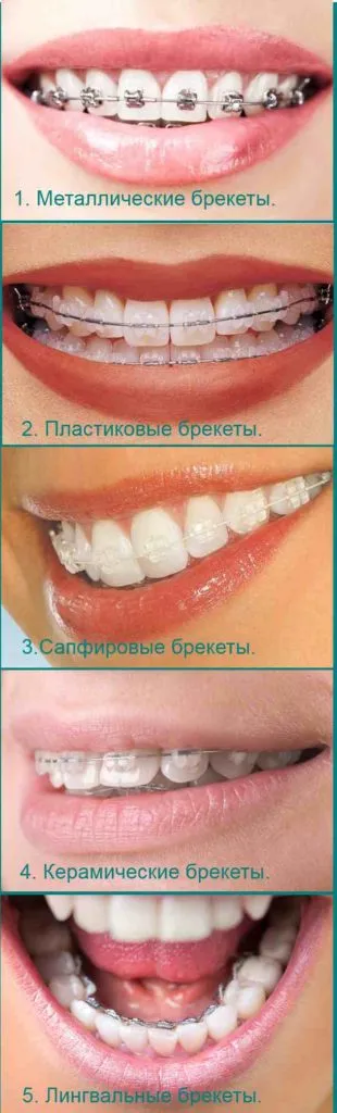 Скоби, които се носят толкова дълго, колкото е необходимо, за да ходят с тиранти