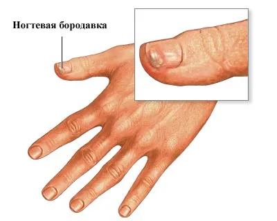 Брадавици, видове брадавици, лечение брадавици