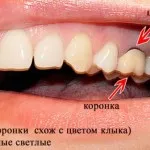 Почернели нокти причиняват, как да се справят с почернял нокът, здравни въпроси (нокти) Почернели нокти причиняват, как да се справят с почернял нокът, здравословни проблеми