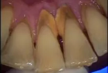 Hogyan periodontális betegség kezelésére tünetek és a betegség megelőzése (kezelt) Hogyan kell kezelni a periodontális betegség tüneteit és a betegségek megelőzése