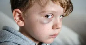 Hogyan kezelik a vérömleny az arcán rájövünk együtt (vérömleny) Hogyan kezelik a vérömleny az arcán megtudja együtt