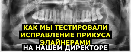 Ahogy teszteltük a harapás korrekciója aligners a mi rendező (a) Ahogy teszteltük a harapás korrekciója aligners a mi rendező