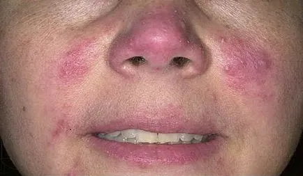 Hogyan kezeljük Rosacea