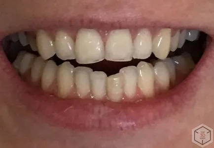 Ahogy teszteltük a harapás korrekciója aligners a mi rendező (a) Ahogy teszteltük a harapás korrekciója aligners a mi rendező