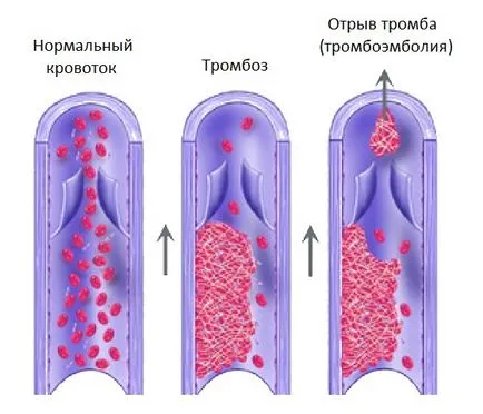 Какво е кръвен съсирек и защо той не се откачи
