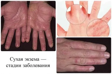 Cuhaya екзема на ръцете, отколкото лечение - подробности