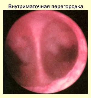 Диагноза преграда в матката