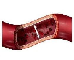 rheumatocelis