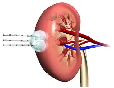 Hyperechoic в бъбреците видове, симптоми, лечение