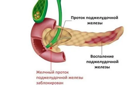 Как боли панкреаса при хора основните симптоми