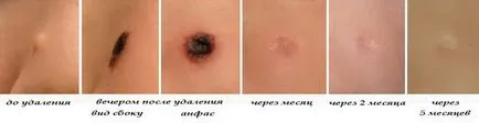 Как за лечение на човешки папилома вирус при жените - подробна информация (папилома) Как за лечение на човешки папилома вирус при жените - подробности