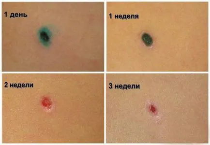 Как за лечение на човешки папилома вирус при жените - подробности Как за лечение на човешки папилома вирус при жените - подробности