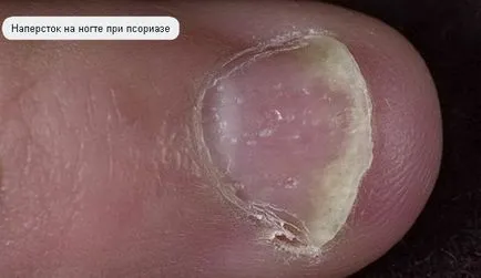 Какво е херпес зостер имат снимки симптоми заболявания при човека