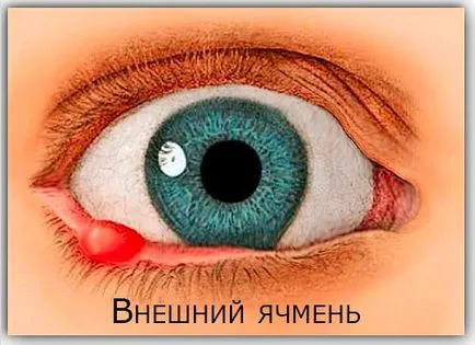 Как да се лекува ечемик на окото у дома (у дома) Как да се лекува ечемик на окото у дома