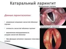 Ларингит как да се отнасяме - блогове - Гледайте филми онлайн с високо качество безплатно