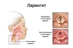 Ларингит как да се отнасяме - блогове - Гледайте филми онлайн с високо качество безплатно