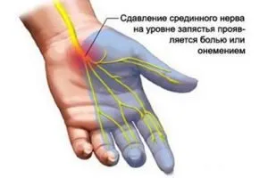 Лечение и Симптоми zudeka синдром на остри и хронични стадии