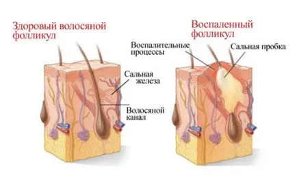 Лекува косопад - лекарства маточина, спрей, мехлем, лосион против косопад (косопад) Лекува косопад - лекарства маточина, спрей, мехлем, лосион против косопад