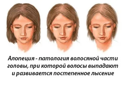 Лечение на алопеция - медицински портал EUROLAB на (алопеция дома) алопеция лечение - медицински портал EUROLAB