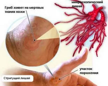 Лекарства за лишаване на лицето, лишавайки видове, симптоми и методи за диагностика