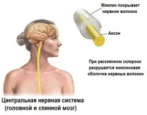 Традиционните лечения за множествена склероза (средства) Народни средства за лечение на множествена склероза