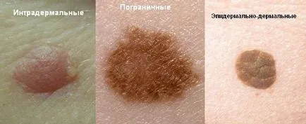 Тяло много причини за рождените белези, невуси видове, кога да отидат на лекар, снимката