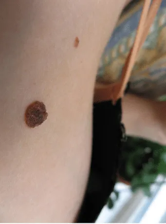 Hogyan, hogy könnyítsen az anyajegy - a leghatékonyabb módszer, hogy feltűnő anyajegy
