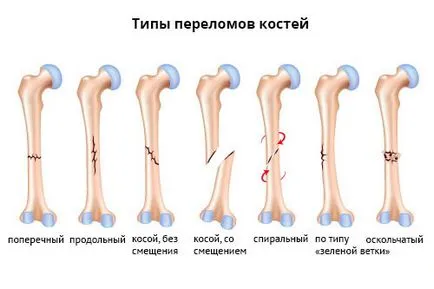 Hogyan lehet meghatározni a zúzódás vagy törés, okeydok