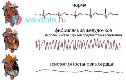 сърдечен арест, асистолия първа помощ, води, третиране