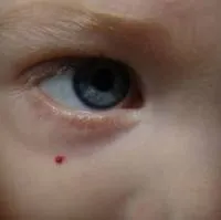 Защо е имало много бенки по тялото, ръцете, гърба, както и дали то е лошо