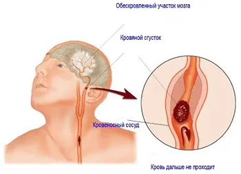 Защо е съсирекът на терена